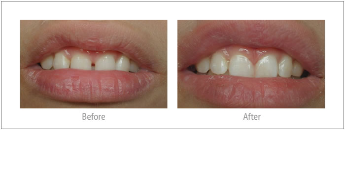 Angelita - Composite Bonding