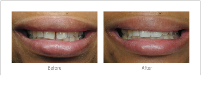 February - Composite Bonding