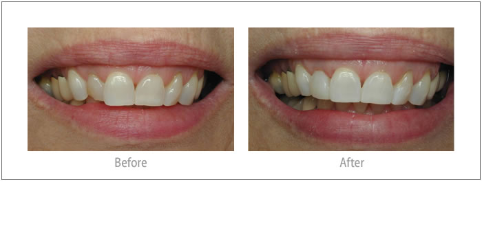 Joann - Composite Bonding