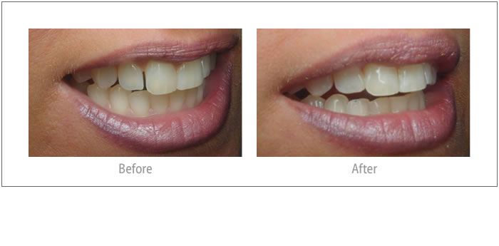 Lisa - Composite Bonding