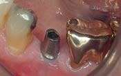 dental implant