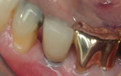 dental implant and porcelain crown