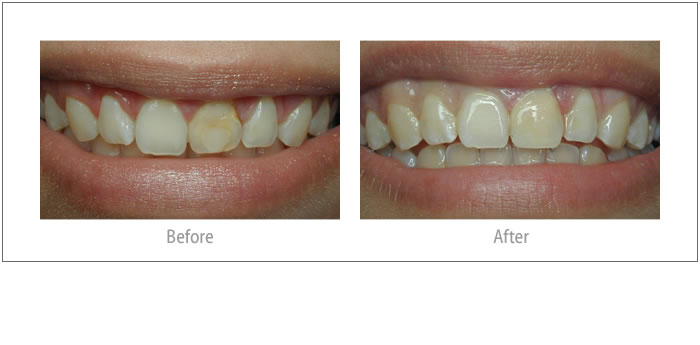 Alejandra - Composite Bonding