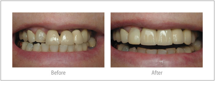 Elaine - Dental Implants, Bridge