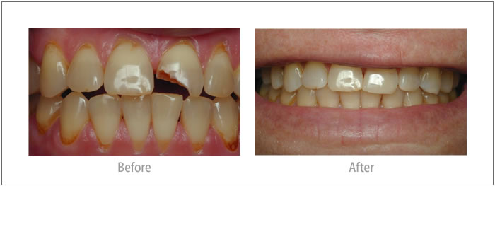 Angela - Composite Bonding