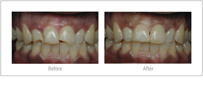 Terrance - Composite Bonding