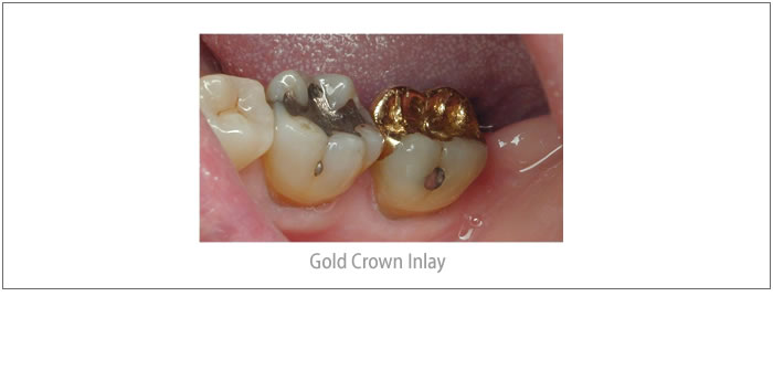 Partial Gold Crowns