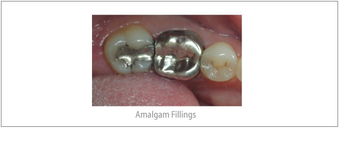 Amalgam Fillings