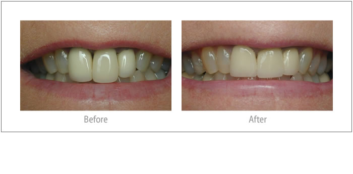 Anita - Porcelain Crowns