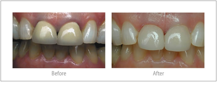 Brenda - Porcelain Crowns